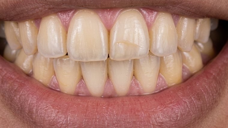 Sonrisa con los dientes oscurecidos, antes del tratamiento