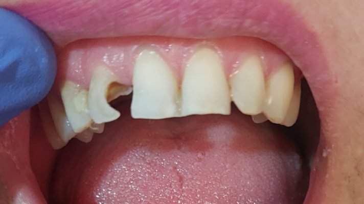 Pieza dental fracturada y con caries, antes del tratamiento