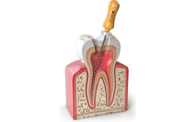 Corte de una pieza dental durante un tratamiento de conducto