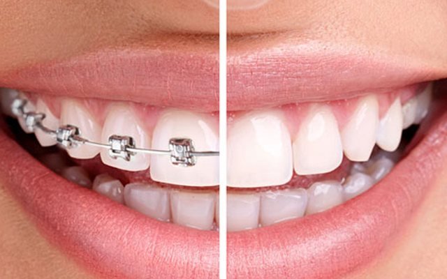 Comparación de una sonrisa con brackets y el resultado final alineado