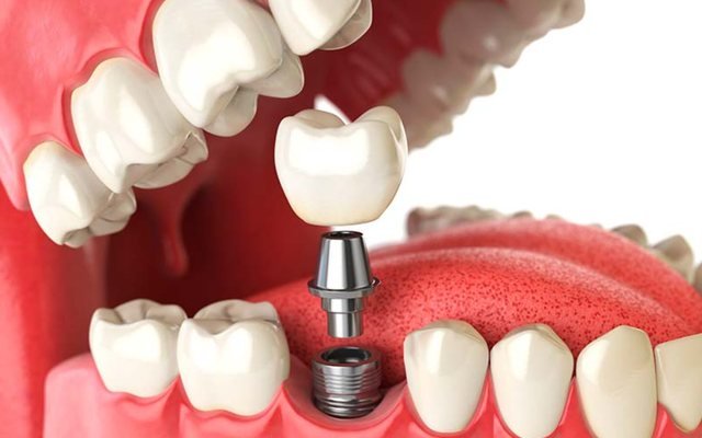Esquema de un implante dental con su corona